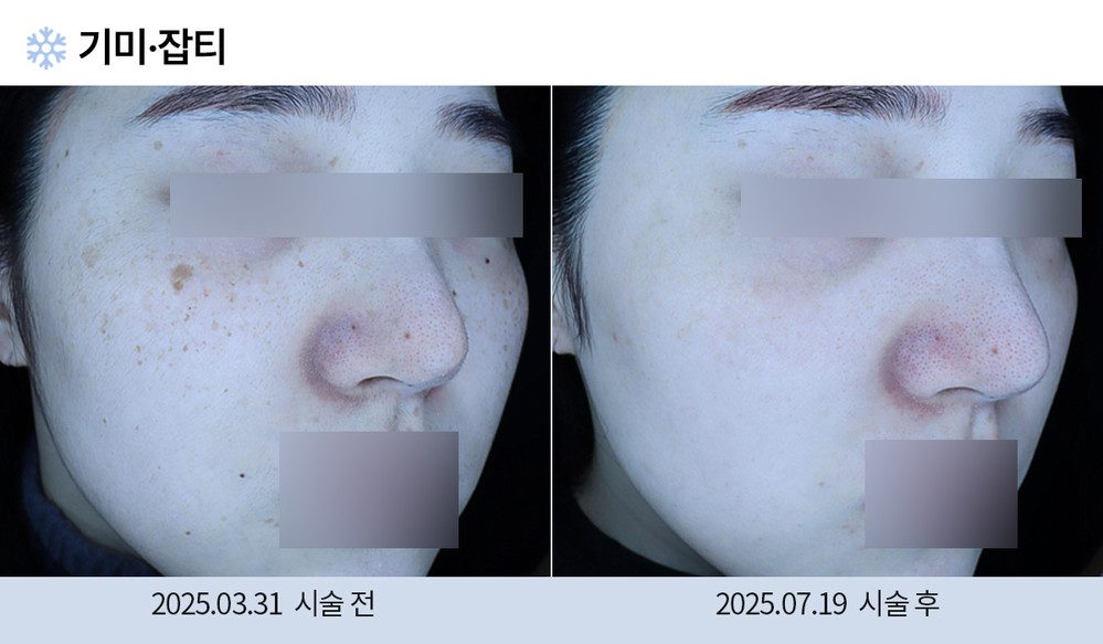 기미 잡티