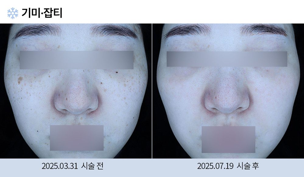 기미 잡티
