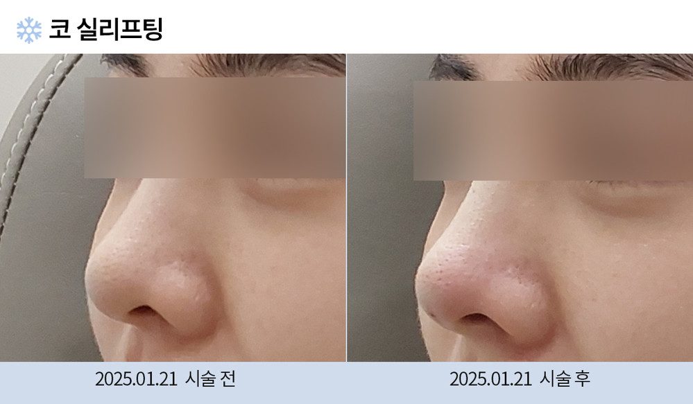 코 실리프팅
